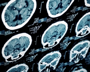 What Is a Traumatic Brain Injury?