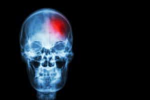 How Car Accidents Lead to Traumatic Brain Injuries
